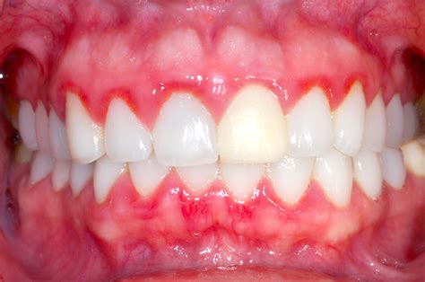 Gingivitis .
